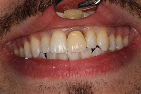 Front Tooth Crown Gold