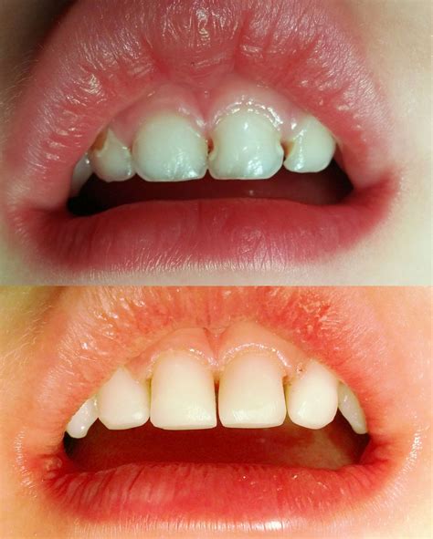 Staining or Cavities on the Front Teeth? | Playtime Dentistry