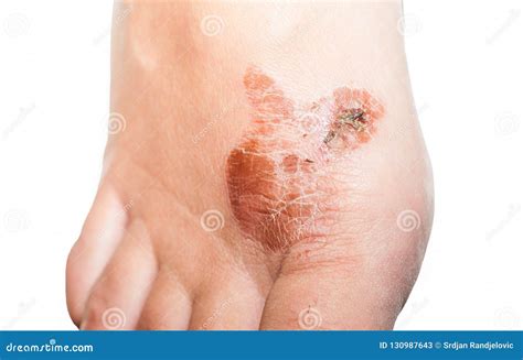 Extreme Bad Foot Skin Bacterial Fungal Infection with Damage Close Up ...