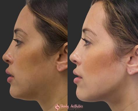 Jawline Fillers - Before & After Results at Skinly