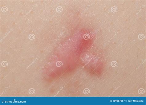 Surgical Removal Of Pyogenic Granuloma On Skin Royalty-Free Stock Photography | CartoonDealer ...