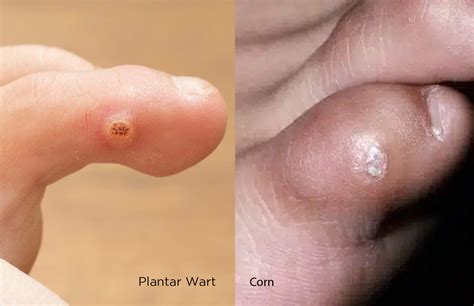 Plantar Wart Treatment: Expert Guide to Causes & Solutions