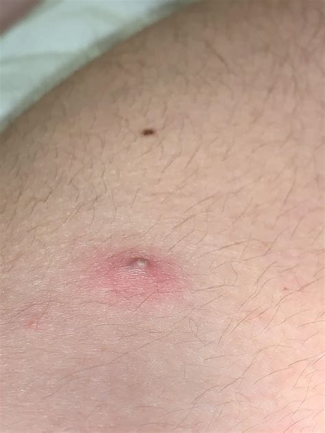 Small pimple like bumps on legs that itch - namefity