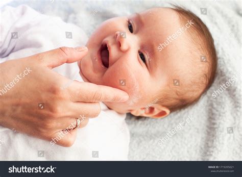 Dry Skin In Babies