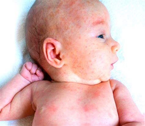 Premium Photo | Baby allergy skin food child dermatitis symptom problem ...