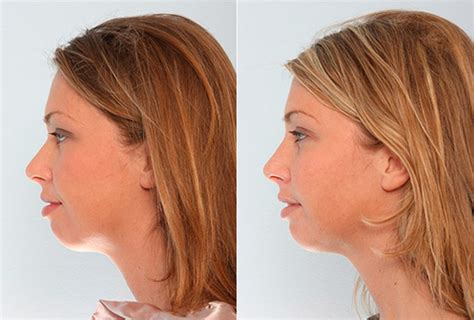 Buccal Fat Pad Removal Photos | Houston, Tx | Patient 27852