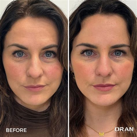 Baby Botox: what's the difference?