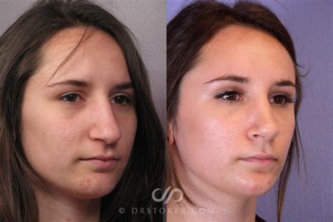 Septoplasty And Turbinate Reduction Before And After