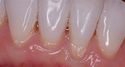 Pinhole Gum Grafting Cost at Joel Kates blog