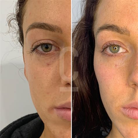 Upper Cheek Filler Cheek Fillers Before And After Photos At Flawless