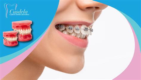 How can braces fix an overbite issue? - Blog