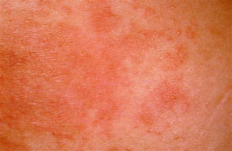 Pathology Outlines - Dermal hypersensitivity reaction