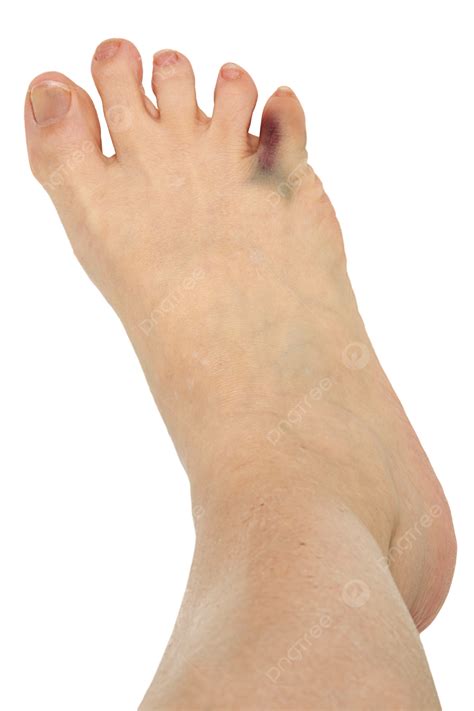 Broken Bruised Toe Over White Skin, Caucasian, Hairline Fracture, Foot ...
