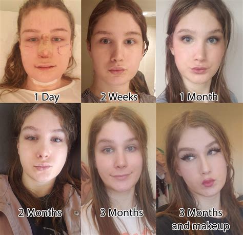 FFS Swelling Timeline [3 Months Post-op Facial Team] | Scrolller