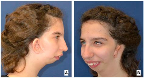 Use of a Fibula Free Flap for Mandibular Reconstruction in Severe Craniofacial Microsomia in ...