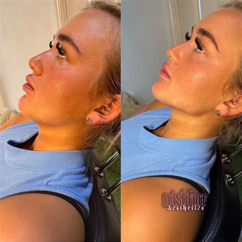 Before and after of jaw enhancement 💕 | Face plastic surgery, Facial fillers, Celebrity plastic ...