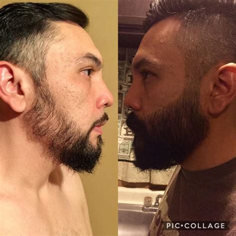 Minoxidil Before And After Beard Result : Good Or Bad Does Rogaine Really Help Grow A Beard ...