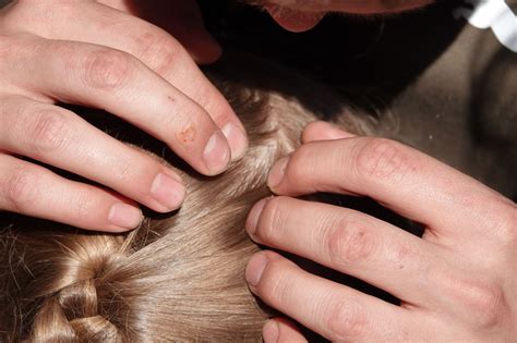 What Is Scalp Acne? How to Treat Pimples on Your Scalp | Allure