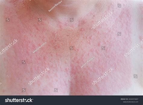There Many Red Small Pimples On Stock Photo 2224371827 | Shutterstock