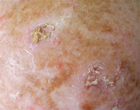 Shorter-Duration Actinic Keratosis Treatments Linked to Higher Patient Adherence and ...
