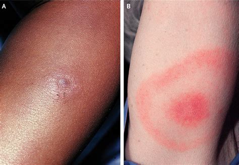 Lyme Can Affect the Heart in Complicated Ways | Madison Area Lyme Support Group