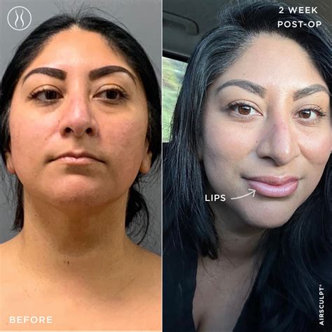 Facial Fat Grafting Explained | AirSculpt