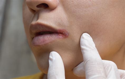 Curing Cracks at Corners of the Mouth Saved Mom’s Life | The People's Pharmacy