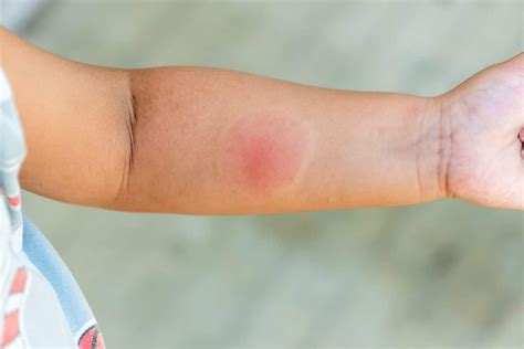 Skeeter Syndrome: Mosquito Bite Symptoms & Treatment | STC