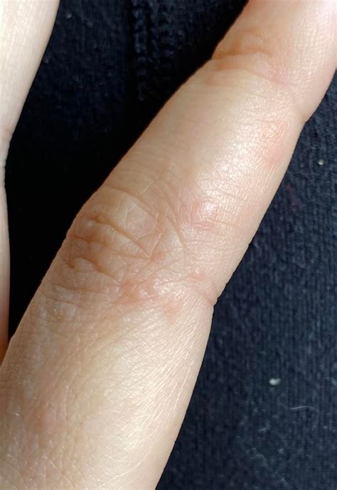 Weird bumps on finger? : r/Psoriasis