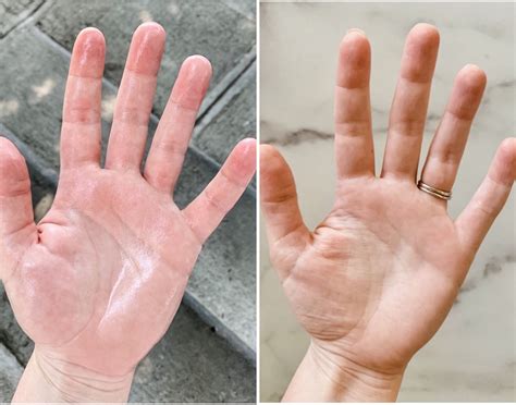 Pin on Hyperhydrosis