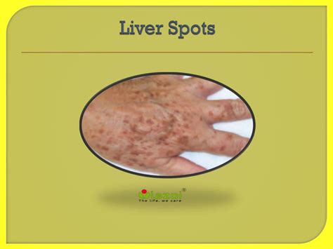PPT - Liver Spots : Causes, Symptoms, Daignosis, Prevention and Treatment PowerPoint ...