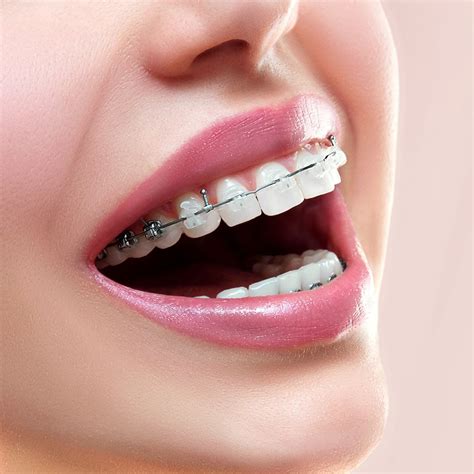 Teen Orthodontics | Affordable Braces for Teenagers in Milwaukee WI, Beloit WI, and Roscoe IL ...