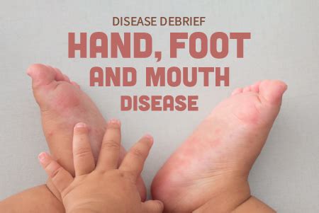 Hand, Foot, and Mouth Disease (HFMD) - National Collaborating Centre ...