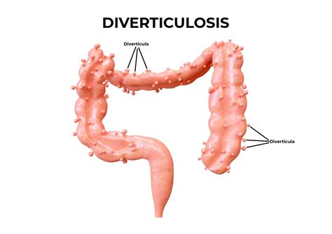 Premium Photo | Diverticulosis is a gastrointestinal disorder in which ...
