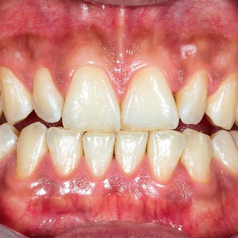 Understanding Gum Recession: 4 Methods To Address It