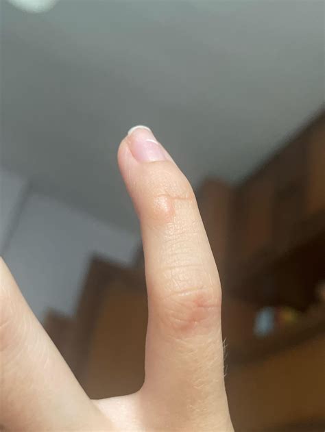 Growing bump on fingerjoint : r/DiagnoseMe