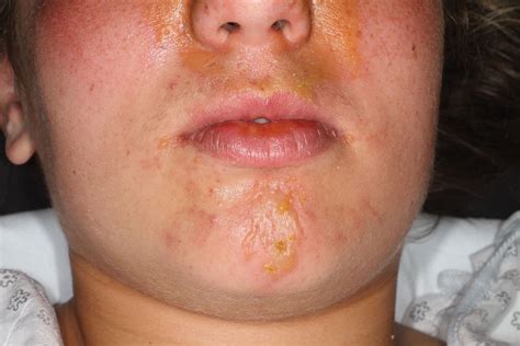 Face Rash With Blisters at Stephanie Cooke blog