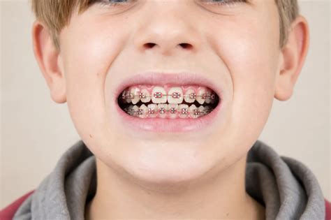 Swollen Gums with Braces - Causes, Treatments & Prevention | NewMouth