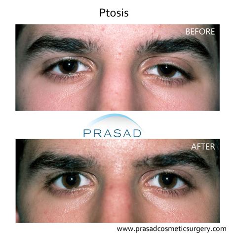 Droopy Eyelid Surgery: Eyelid Ptosis Procedure, and Recovery