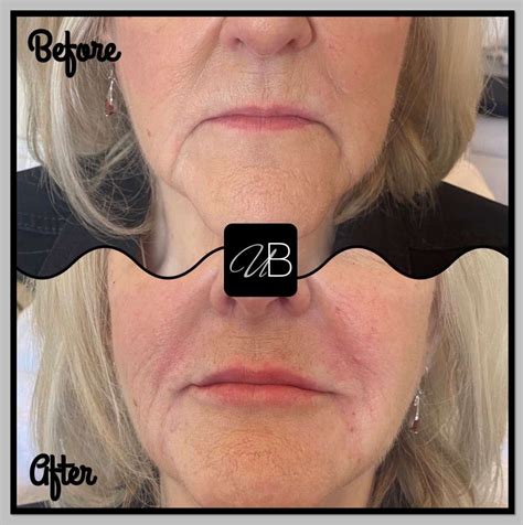 How can I improve my downturned smile?