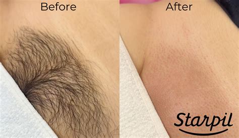 How to Prep for a Brazilian Wax: A Step-by-Step Guide – Starpil Wax