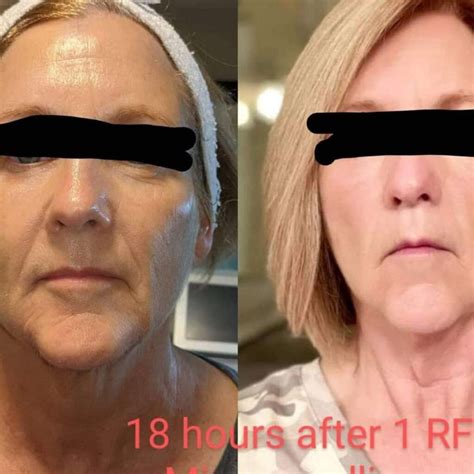 Radio Frequency Microneedling Machine - Advanced Aesthetics Academy & Spa