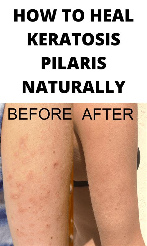 How to heal keratosis pilaris from the inside out – Artofit