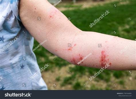 Severe Poison Ivypoison Oak Rash Reaction Foto Stok 1758184889 ...