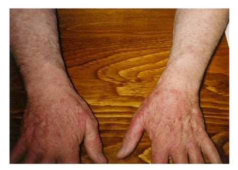 Presentation of Acrodermatitis Chronica Atrophicans Rashes on Lyme ...