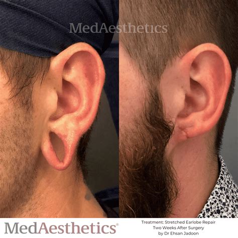 Stretched Earlobe Repair Perth | Torn Earlobes Surgery