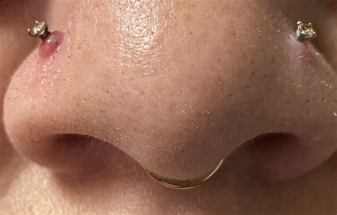 Are Nose Piercing Bumps Permanent at Victoria Gregory blog