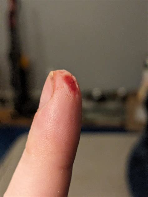Cut a good chunk of my finger off, thoughts? : r/woundcare
