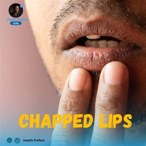 Say Goodbye to Chapped Lips: Causes, Treatments, and Prevention 💋 ️" Chapped lips, also known as ...