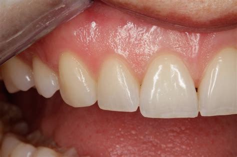 What Do Healthy Gums Look Like? — Nova Smiles